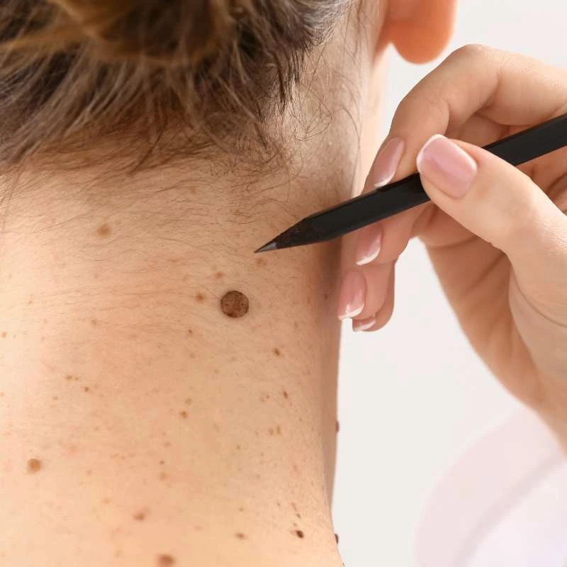 How to Support Your Body During Pregnancy for Faster Postnatal Recovery 5 See our lesion removal prices Brockenhurst - call today for a free quote